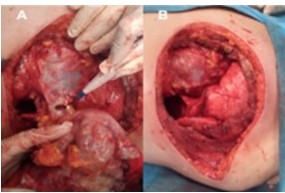 A. Disecci�n del pericardio. B. Defecto en el pericardio.