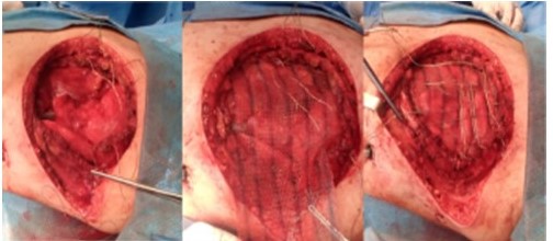 Estabilizaci�n de pared costal (4o, 5o y 6o arco costal anterior) mediante entramado horizontal y vertical con alambre de Kirchner, previa colocaci�n de malla de Proceed�