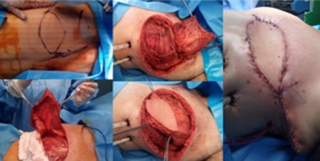 Confecci�n de colgajo del dorsal ancho para cubrir defecto definitivo