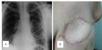 A: radiolog�a pos quir�rgica. B: t�rax hipo-expansible.