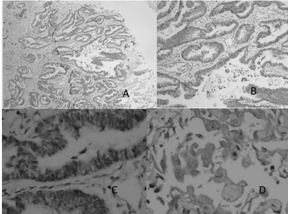 Caso de carcinoma positivo para EGFR: A.- 4.- ADC patr�n predominantemente acinar positivo para EGFR; B.- 10X estructuras acinares revestidas por epitelio cil�ndrico con expresi�n EGFR; C.- 40X; D.- ADC poco diferenciado positivo para EGFR.