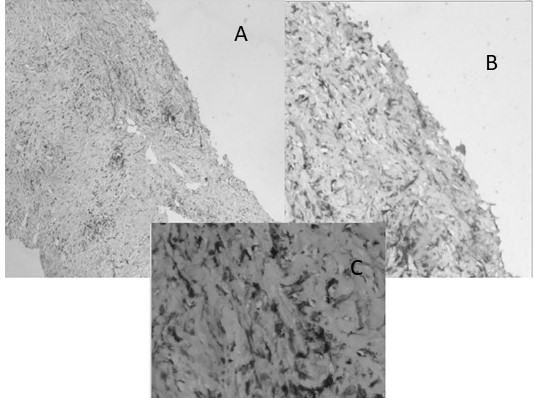 Caso de carcinoma de pulm�n ALK positivo: A.- La lesi�n muestra poca diferenciaci�n 4X IHQ; B y C: las c�lulas son fuertemente positivas para ALK IHQ 10X y 40X
