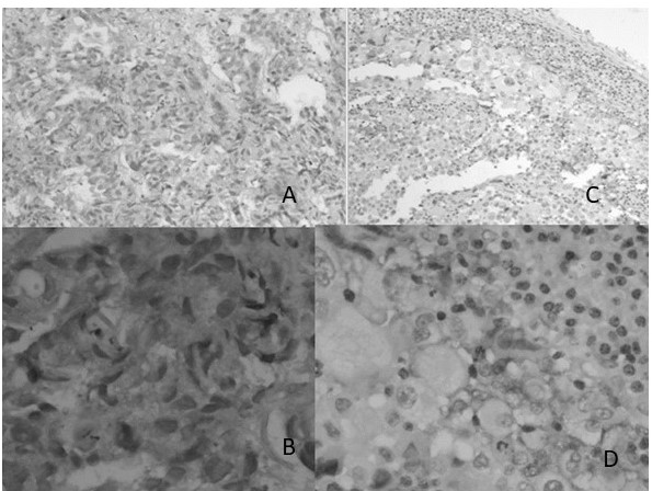 Casos con expresi�n PD-L1: A y B Carcinoma poco diferenciado positivo para PD-L1 4X y 40X IHQ; C y D Carcinoma adenoescamoso con inmunomarcaje fuerte de membrana de interfaz tumor- c�lulas inmunes.