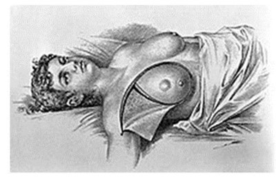 Incisi�n de mastectom�a en trabajo original de Halsted