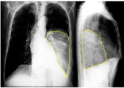 (A y B) Radiograf�a de t�rax en vista anteroposterior y lateral Se observa una imagen densa heterog�nea en del pulm�n izquierdo que ocupa todo el tercio inferior del hemit�rax (l�nea punteada amarillas).