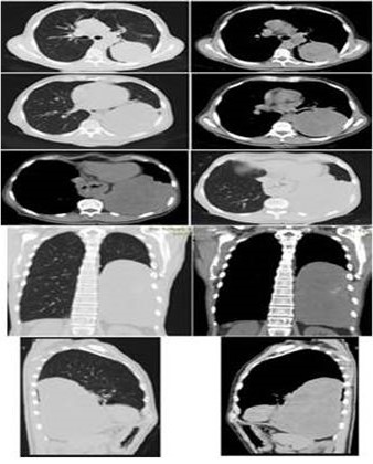TC, se observa lesi�n de tejido blando ovalada de contornos parcialmente definidos con contacto pleural.