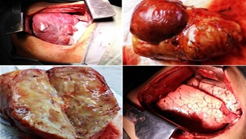Pieza quir�rgica con un peso de 250 g, correspondiente a lesi�n tumoral adenocarcinoma mucinoso con patr�n de crecimiento &ldquo;lep�dico&rdquo;, extirpado del segmento lingular del l�bulo superior izquierdo. Lecho quir�rgico despu�s de resecado el tumor