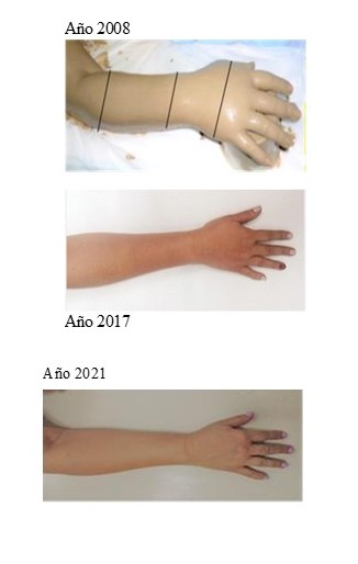 Linfedema en mano y antebrazo, MSD.