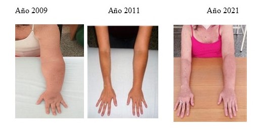 Linfedema en mano, antebrazo y brazo MSI