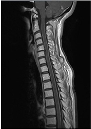 Resonancia magnética de columna en T1 que demuestra realce en leptomenínges