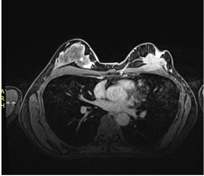 Resonancia magnética de mama mostrando lesiones sólidas en ambas mamas