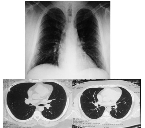 Im�genes Iniciales: radiograf�a de t�rax. Figura 1. Imagen tipo nodular perif�rica en el 1/3 medio del pulm�n derecho, de 1 cm de di�metro aproximadamente, sin calcificaciones en su interior y bien delimitada (flecha negra). Figura 2. Tomograf�a tor�cica: lesi�n nodular localizada a nivel de segmento lateral de l�bulo pulmonar medio que mide aproximadamente 11 mm x11 mm x 20 mm con un coeficiente 32 UH, de contornos bien definido sin calcificaciones en su interior resto del estudio sin alteraci�n (Flechas blancas).