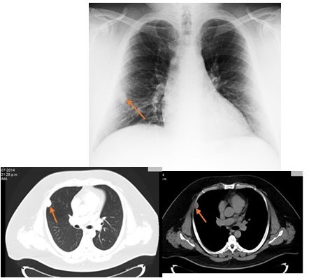 Im�genes control: Figura 3. Se aprecia aumento de tama�o a 3 cm de di�metro aproximadamente de la lesion sin otros cambios significativos (Flecha roja). Figura 4. Tomograf�a tor�cica:  imagen de patr�n nodular localizada a nivel de segmento lateral de l�bulo pulmonar medio que mide 2,5 cm x 1,8 cm de di�metro anteroposterior y transversal con un coeficiente de 27 UH (Flechas roja).