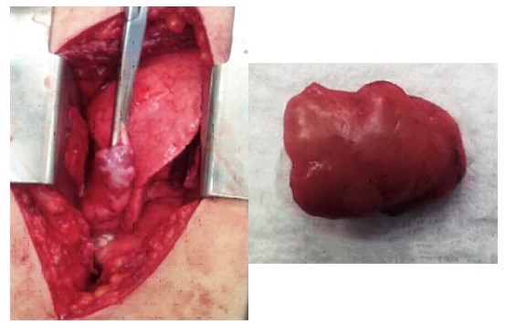 Toracotom�a posteror lateral derecha tor�cica a nivel del 6o espacio intercostal con ex�resis de la lesi�n nodular localizada en el par�nquima pulmonar del l�bulo medio segmento lateral, con m�rgenes bien definidos y constituido por tejido conectivo tipo fibroso, sin signos de malignidad que mide 2  cm x 2 cm x 1 cm aproximadamente por lo que se realiza resecci�n subsegmentaria.