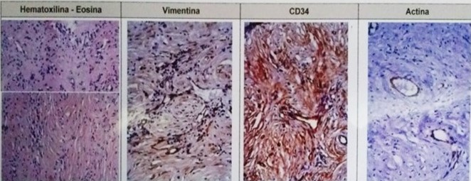 Microfotografia inmunohistoqu�mico: estreptavidina-biotina y utilizando el m�todo de recuperaci�n ant�genica y controles positivos adecuados. Vimentina positiva en c�lulas estromales, CD34 positivos en vasos sangu�neos, actina positiva en paredes de los vasos, queratina AE1-AE3 y prote�na S100 fueron negativos. Tumor miofibrob�astico inflamatorio de pulm�n.