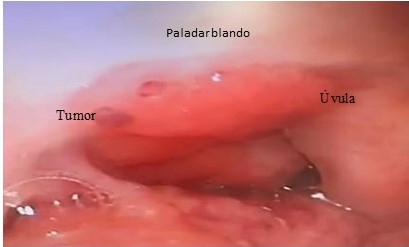 Lesión en amígdala - paladar blando derecho.