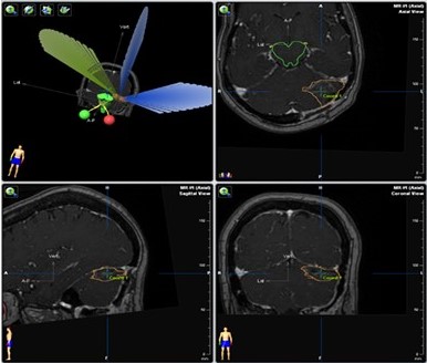Plan de tratamiento de paciente con carcinoma de mama y MC solitaria resecada. Recibi� RCE posoperatoria, fracci�n �nica, dosis de 2 000 cGy, empleando 3 arcos con colimador micro-multil�minas.
