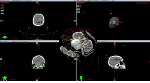 Plan de tratamiento de un paciente con 4 MC tratadas con TAVM empleando 6 arcos. Recibi� RCE con esquema de hipofraccionamiento, 5 fracciones de 600 cGy.