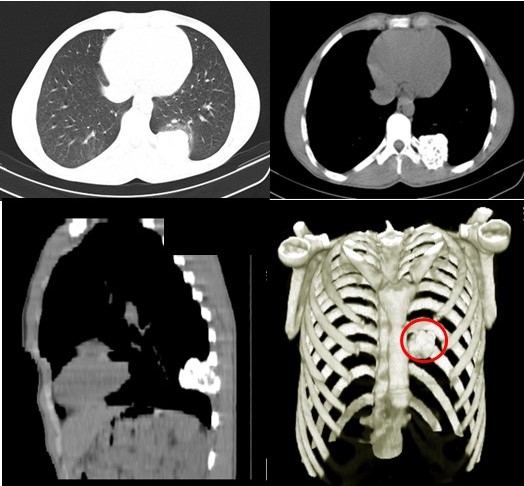 Tomograf�a de t�rax multidectector corte axial y reconstrucci�n 3D: lesi�n �nica ocupante de espacio afectando d�cimo (10o) arco costal posterior izquierdo expansiva, porci�n central hipodensa de comportamiento osteol�tico, con remodelaci�n, adelgazamiento y expansi�n de la cortical (C�rculo punteado).