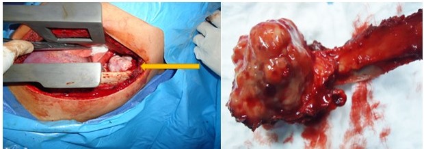 Toracotom�a postero lateral izquierda a nivel del 9o espacio intercostal con resecci�n quir�rgica de los 2/3 proximales del 10o arco costal posterior izquierdo con su desarticulaci�n costo vertebral.