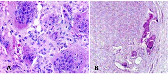 Microfotograf�a. A) Tumor de c�lulas gigantes benigno, las c�lulas gigantes aparecen distribuidas uniformemente, rodeadas por c�lulas mononucleadas. Las c�lulas gigantes son de gran tama�o y poseen numerosos n�cleos que muestran las mismas caracter�sticas que las c�lulas mononucleadas. B) crecimiento expansivo con erosi�n end�stica de la cortical.