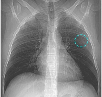 Radiograf�a de t�rax: defecto localizado en el �ngulo externo del sexto (6o) arco costal izquierdo, (circulo punteado verde).
