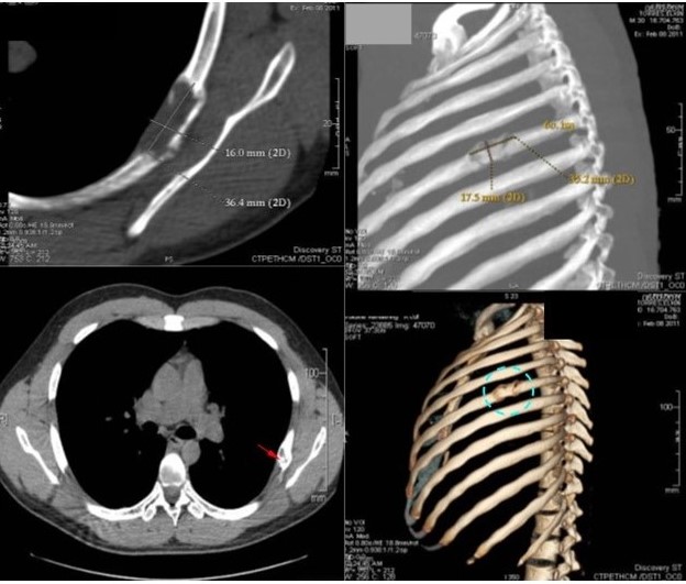 Tomograf�a con reconstrucci�n 3D: lesi�n �nica ocupante de espacio afectando sexto (6o) arco costal posterior izquierdo expansiva, porci�n central hipodensa de comportamiento osteol�tico, con remodelaci�n, adelgazamiento y expansi�n de la cortical.