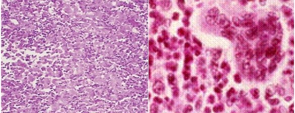 Microfotografia. Consiste en una proliferaci�n de car�cter granulomatoso de c�lulas de Langerhans entremezcladas con c�lulas de la inflamaci�n, en la que se encuentran abundantes eosin�filo e histiocitos.