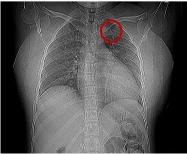 Radiograf�a de t�rax: Defecto localizado en el �ngulo interno del tercer (3er) arco costal izquierdo, de aspecto l�tico con aparente abombamiento del periostio y perdida de sustancia �sea.