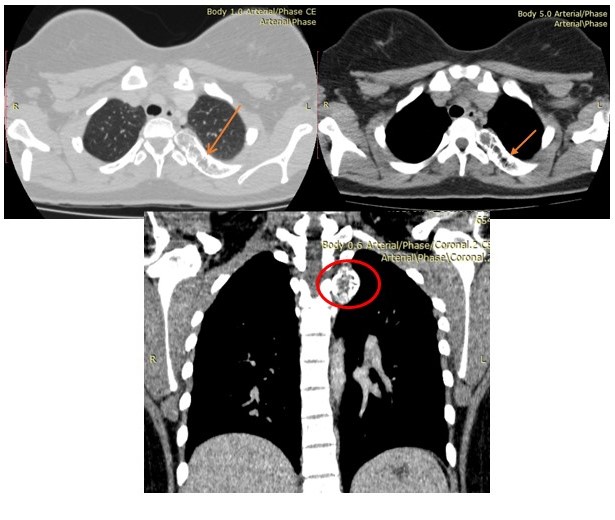 Tomograf�a de t�rax multidectector Corte axial y coronal: lesi�n �nica ocupante de espacio afectando tercer (3er) arco costal posterior izquierdo expansiva, porci�n central hipodensa de comportamiento osteol�tico, con remodelaci�n, adelgazamiento y expansi�n de la cortical.