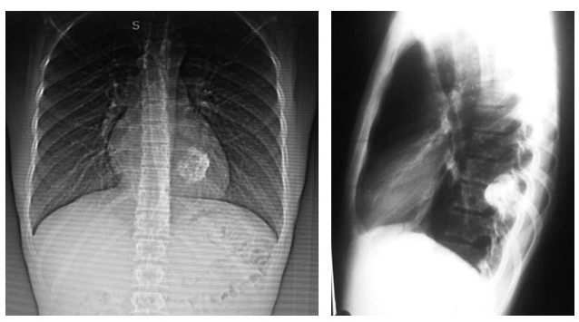 Radiograf�a de t�rax: defecto localizado en el �ngulo interno del d�cimo (10o) arco costal izquierdo, de aspecto l�tico con aparente abombamiento del periostio y perdida de sustancia �sea (pompas de jab�n).