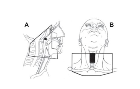 Diagrama de campos laterales opuestos que abarcan la nasofaringe y el cuello superior (A). Diagrama del campo anterior empleado en la irradiación del cuello inferior (B).