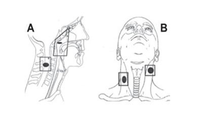 Diagrama de los campos reducidos (laterales opuestos) empleados en el tratamiento de la nasofaringe y del campo reducido directo con electrones para la irradiación de metástasis cervicales situadas sobre la médula espinal (A). Diagrama de campos reducidos AP-PA empleados en la irradiación de metástasis cervicales, evitando la médula espinal (B).