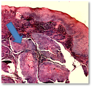 Espec�menes de laringoscopia directa (H-E)