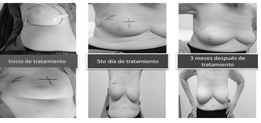 Evolucin de nuestra paciente tratada con RTUF, IMRT.