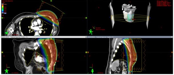 RT Ultrafraccionada con RTC3D 