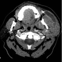 Corte axial de TC, donde se observa tumor submaxilar s�lido con �reas qu�sticas.