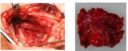 Lecho quir�rgico de submaxilectom�a (A). Pieza quir�rgica submaxilectom�a lobulada (B).