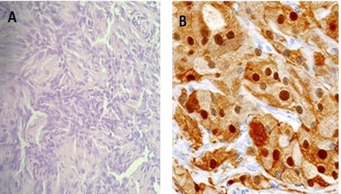Corte histol�gico con H&E con caracter�sticas compayibles con Schwannoma (A) e IHQ positiva para S-100 (B)