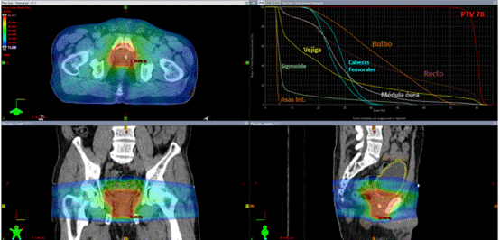 Plan de tratamiento con TAVM. Se observa la distribución porcentual de la dosis indicada por los diferentes colores en el plano axial, coronal y sagital, más el histograma dosis - volumen.