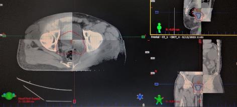 Tomografía de haz cónico que toma el sistema OBI (On Board Image) la cual se superpone con la tomografía de simulación dónde se verifica el volumen y posición diaria de la vejiga, próstata y recto, posterior a realizar el ajuste de posicionamiento con la RRD