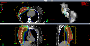 Tratamiento radiante con t�cnica conformada 3D