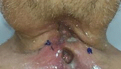 Fstula faringocutnea y faringotraqueal