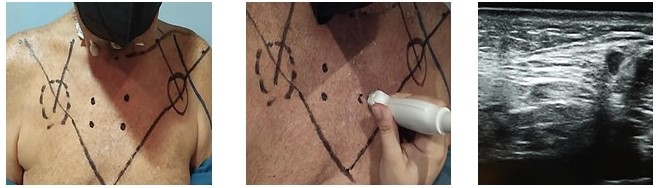 Ubicacin y demarcacin de las perforantes.