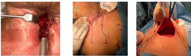 Diseo del colgajo de 1a intervencin quirrgica.