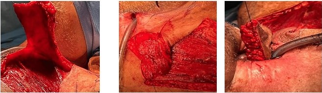 Diseo del colgajo de a primera intervencin quirrgica