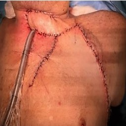 Resultado final de la primera intervencin quirrgica