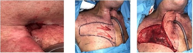 Diseo del colgajo de la segunda intervencin quirrgica