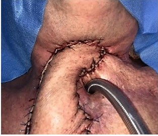 Resultado final de la segunda intervencin quirrgica