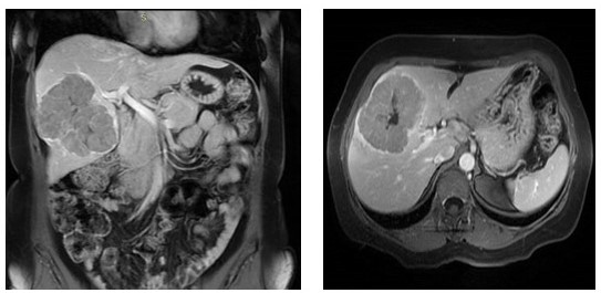 Im�genes de resonancia magn�tica abdominal, evidenciando la lesi�n hep�tica en l�bulo hep�tico derecho